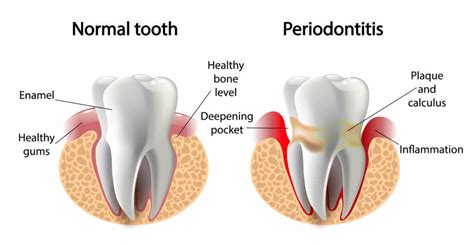 periodontal disease rhode island dental arts