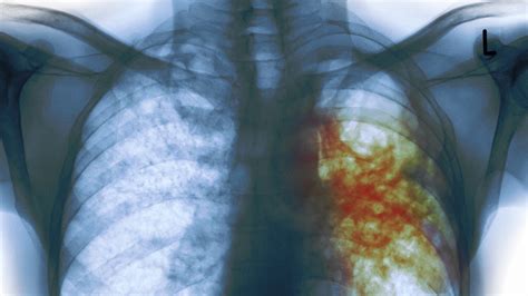 tuberculosis cases suddenly jump     york city largest