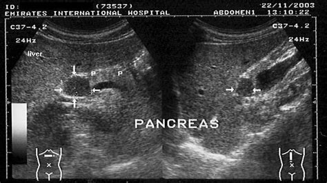 On Radiology A Pancreatic Mass Or Just Papillary