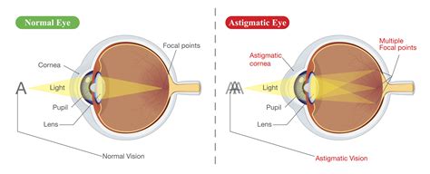 astigmatism     im  suitable  laser eye surgery vision surgery