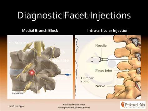 lumbar facet joint nerve injections  treating chronic   pain youtube