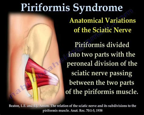 piriformis syndrome sciatica      dr
