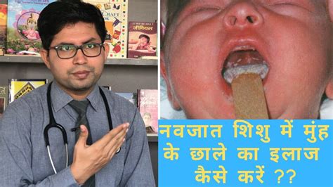 oral candidiasis oral white patch   manage oral thrush