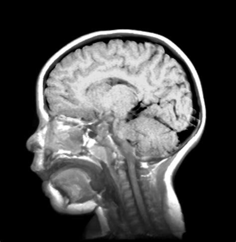 hersenscan niet geschikt voor diagnose de standaard