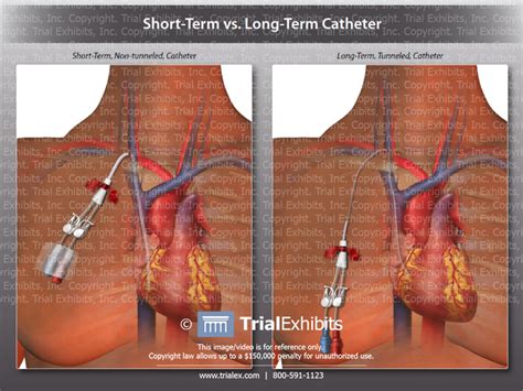 short term vs long term catheter trialexhibits inc