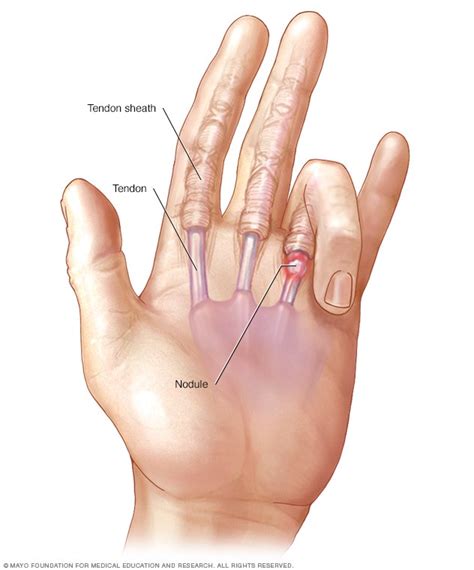 Trigger Finger Symptoms And Causes Mayo Clinic