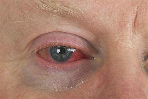 chronic fatigue syndrome   eyes