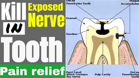 nerve pain  tooth