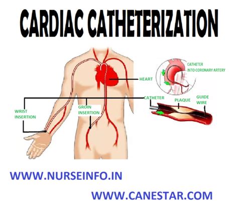cardiac catheterization nurse info