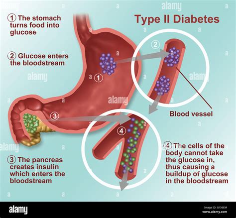 llustration  insulin  glucose production  type  diabetes stock