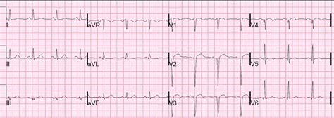 Dr Smith S Ecg Blog December 2011