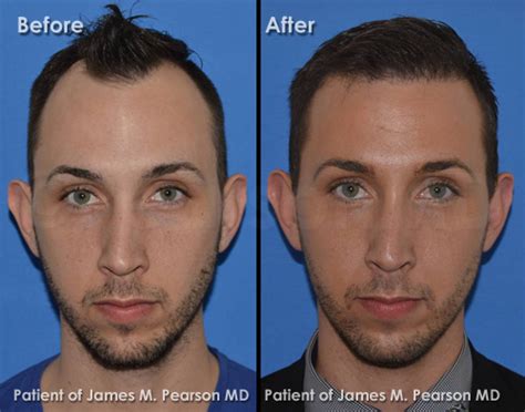 Facial Waviness After A Facelift