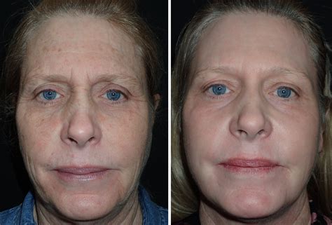laser resurfacing richmond va  laser skin treatment remove wrinkles