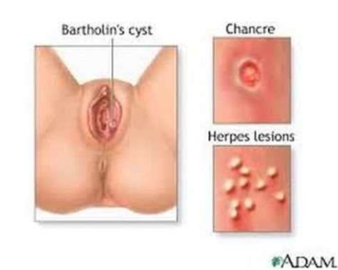 Can you have sex when on bactrim