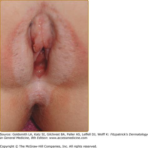 prepubertal female genitals