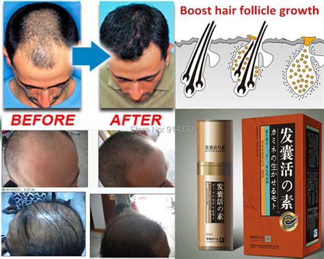 mlpack boost hair growth loss product hair growth product natural remedies anti hair loss