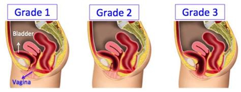 Prolapsed Bladder Cystocele Grade 1 Can Be Treated