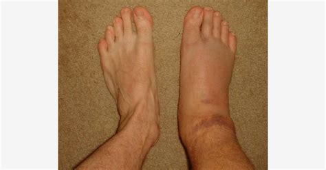 difference  swollen foot  regular   image  healthool