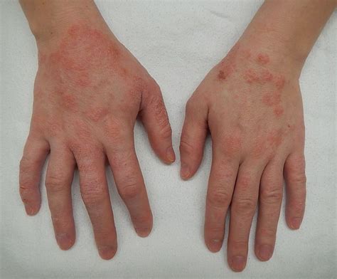 eczema symptoms  treatment hubpages