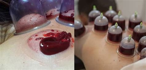 Video Picture Of Traditional Asian Medicine Tcm Cupping
