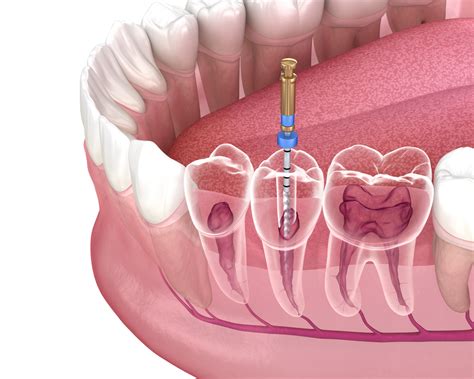 ramsey endodontics ramsey dental spa