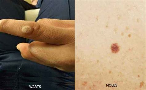 how to get rid of skin tags and moles best way to