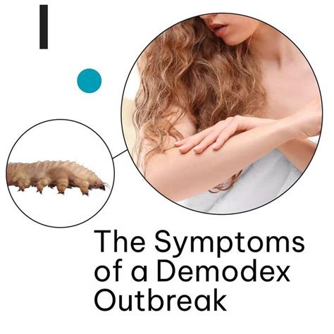 demodex mites        skin  hair