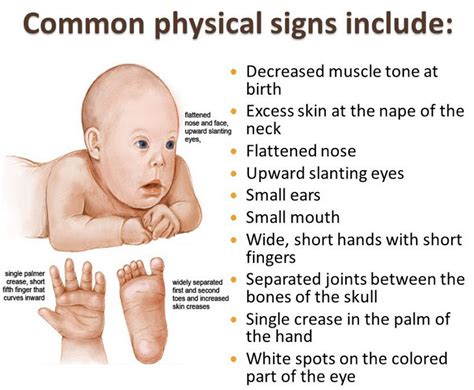 Facial Features Of Down Syndrome Nude Pics