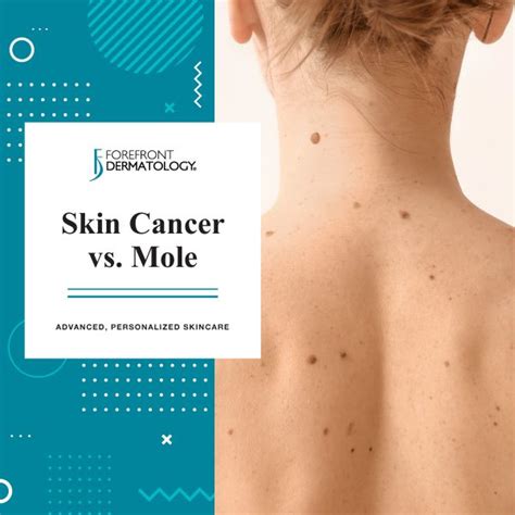 Skin Cancer Vs Mole Forefront Dermatology