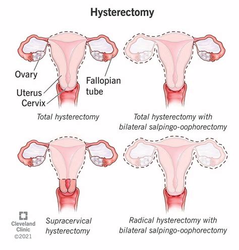 Pin On Hysterectomy