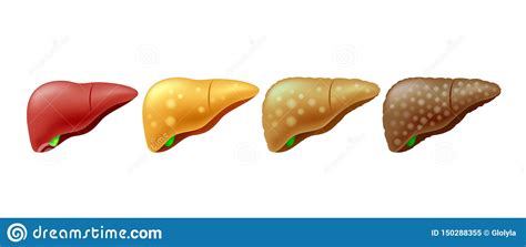 Stages Of Liver Damage Liver Disease Stock Vector Illustration Of