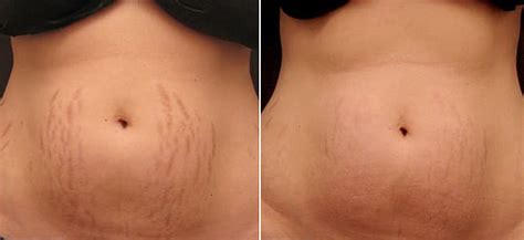laser treatment for stretch mark removal andrea catton
