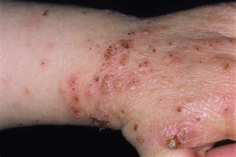 dust mites   carriers  bacteria causing ige sensitization  dermatitis