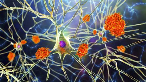alzheimers disease progression slowed   microglia activation
