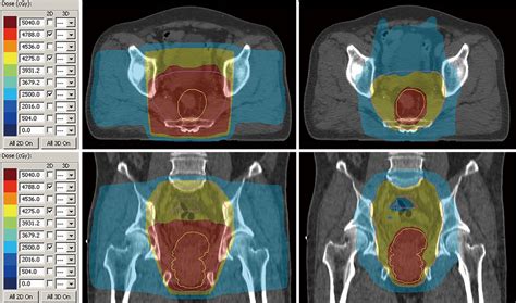 radiation therapy for rectal cancer tseng journal of