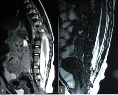 a t2 weighted sagittal image of a patient showing thickened filum