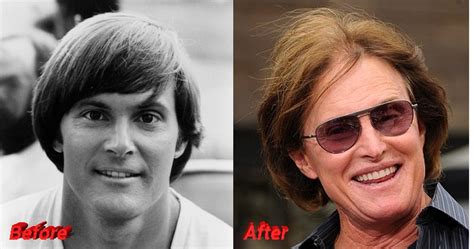 bruce jenner plastic surgery from male athlete to female star