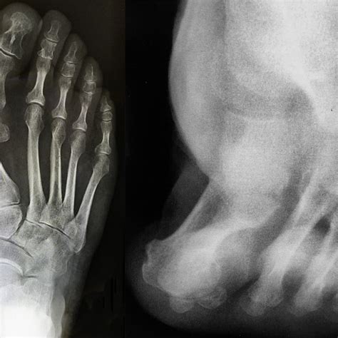 triplane hallux abducto valgus classification