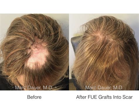 fue hair transplant  scalp scar marc dauer md hair transplant