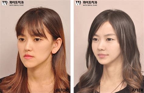 Chirurgie Esthétique En Corée Plus Impressionnant Que