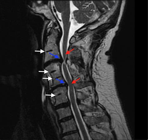 cureus images  spine  rare abnormal bony fusion