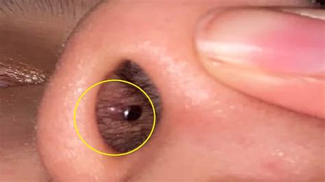 how to get rid of a piercing bump inside your nose naturally youtube