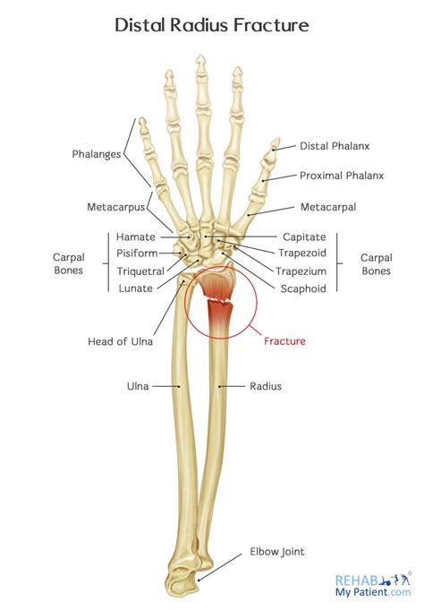 distal radius fracture rehab  patient
