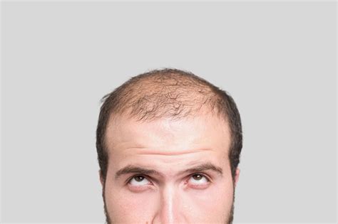 short white men     bald study abs cbn news