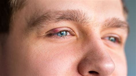 eye infections pinkeye treatment college station tx urban optics