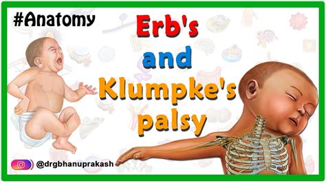erbs palsy  klumpkes palsy usmle animation etiology clinical features diagnosis