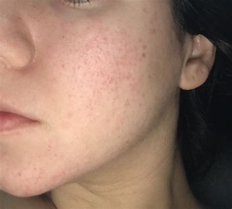 helppp    acne rosacea pictures included rosacea facial redness acneorg