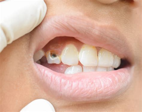 front tooth cracked springvale dental clinic