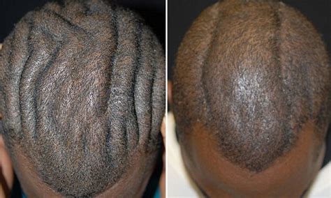 perfect man  brainy scalp   life changing surgeries daily mail