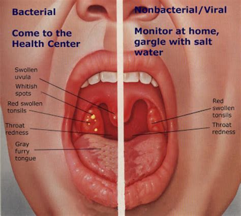 strep throat hubpages